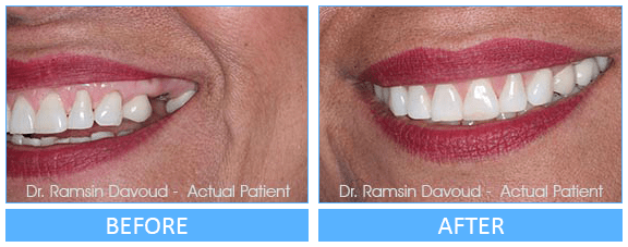 Smile Gallery Turlock - Implant Dentistry Before after image-01