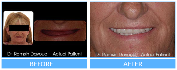 Smile Gallery Turlock - Implant Dentistry Before after image-02