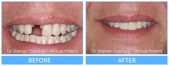 Smile Gallery Turlock - Implant Dentistry Before after image-03