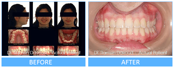 Smile Gallery Turlock - Orthopedic Orthodontics Before after image-01