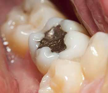 how dental amalgam is removed safely