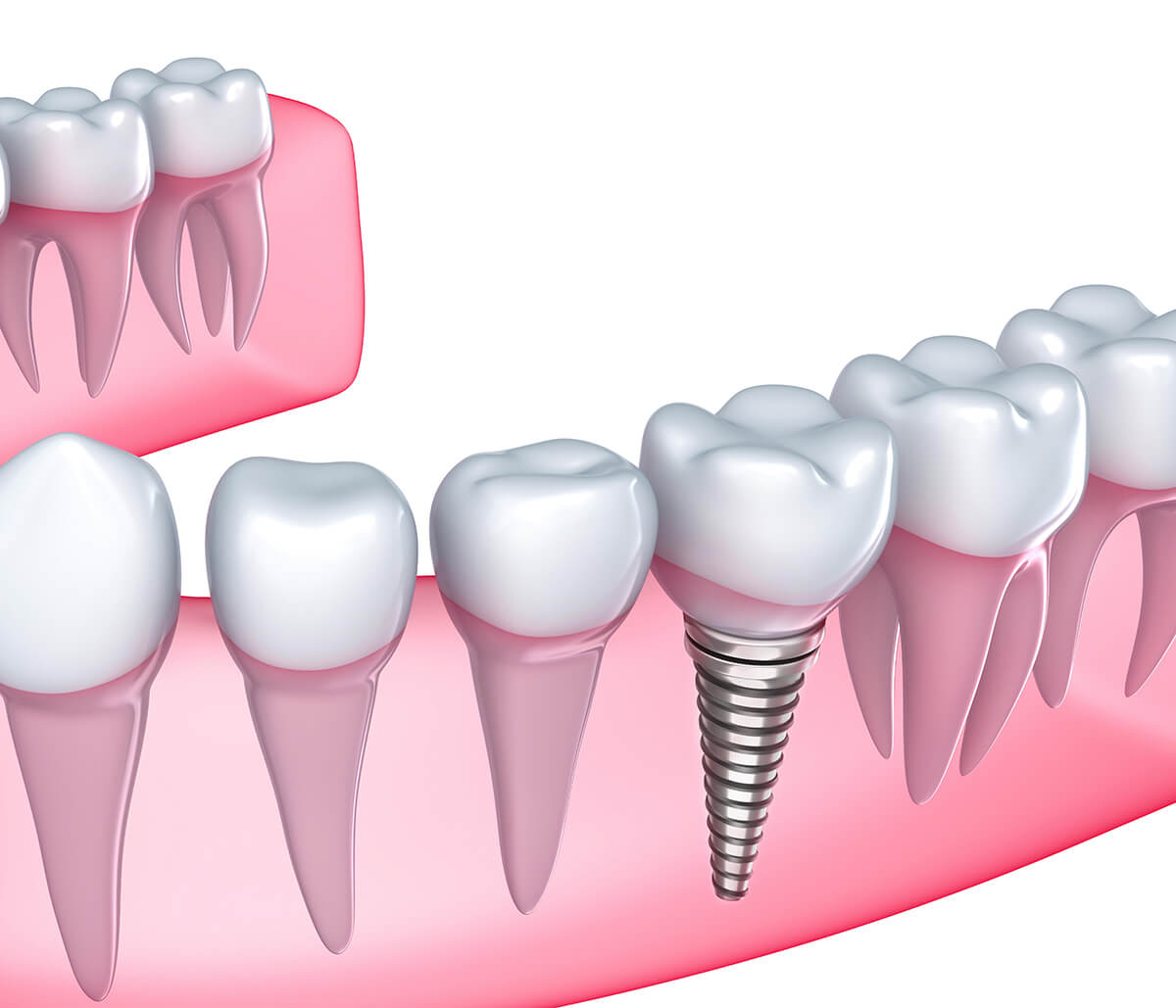 Rebuild Your Smile with Dental Implant Technology at an Advanced Dentist Office in Turlock, CA Area