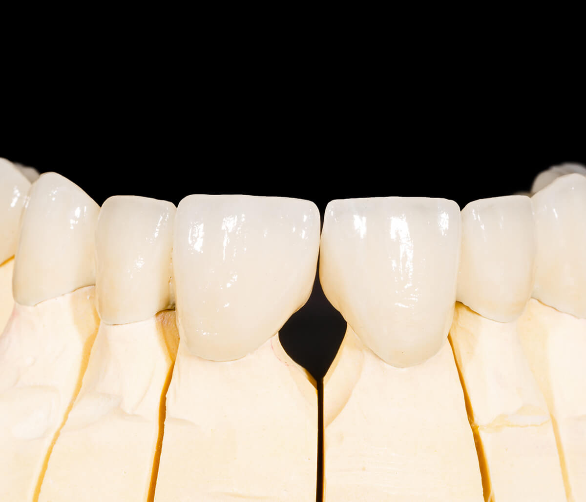 Cost of Zirconia Tooth Replacement Implants in Turlock CA Area