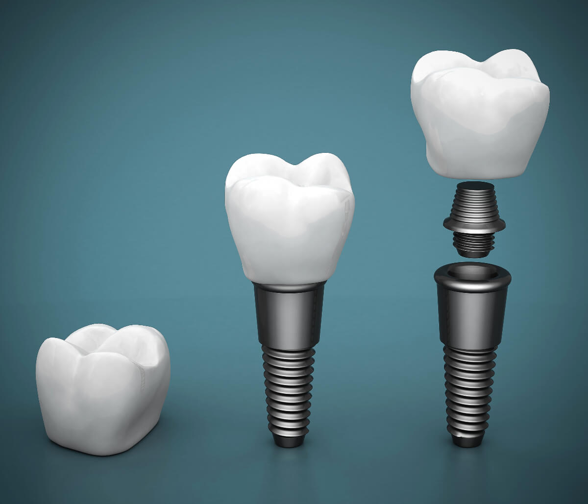 Ceramic Dental Implants in Turlock CA area