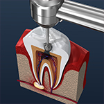 Dental Video - Root Canal
