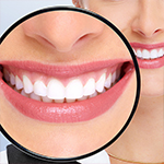 Dental Video - Teeth Whitening