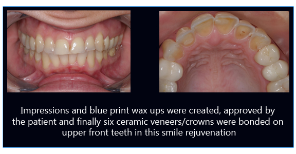Smile Rejuvenation Veneers/Crowns Image 2
